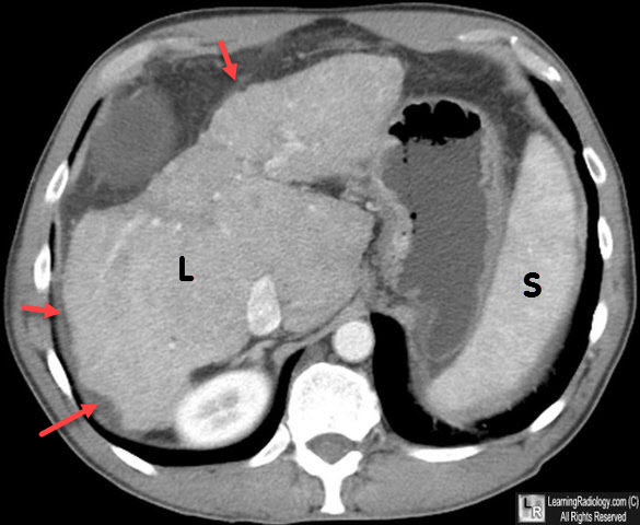 Cirrhosis, CT